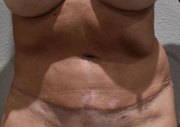 Tummy Tuck (Abdominoplasty): Case 549 - After
