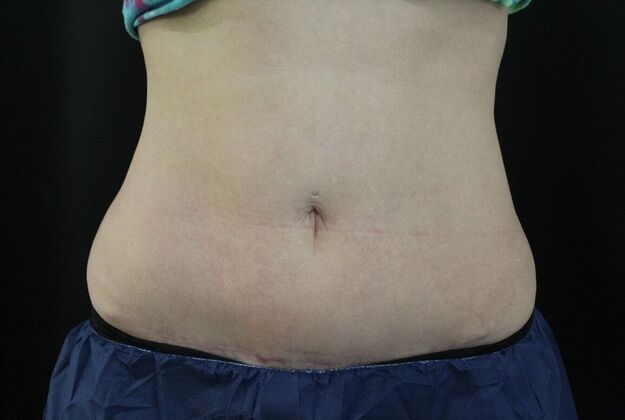 CoolSculpting Case 12 - Before