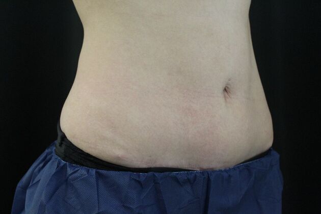 CoolSculpting: Case 12 - Before