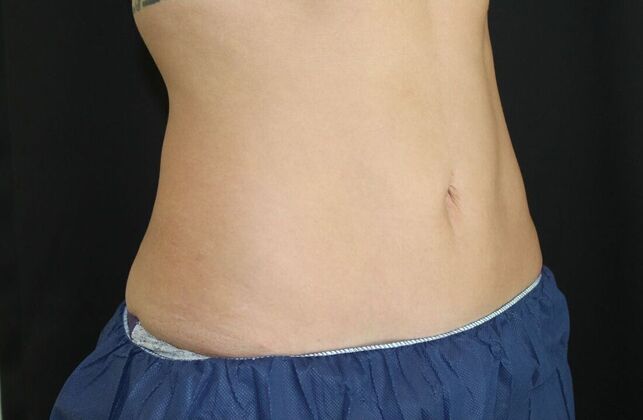 CoolSculpting: Case 12 - After