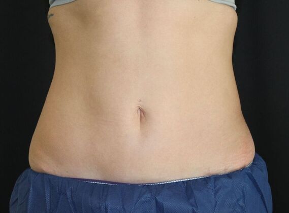 CoolSculpting Case 12 - After