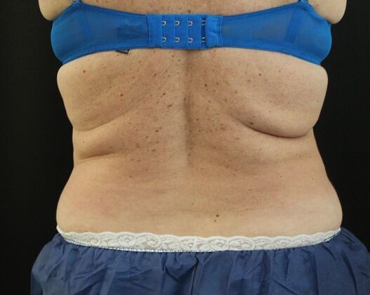 CoolSculpting Case 13 - Before