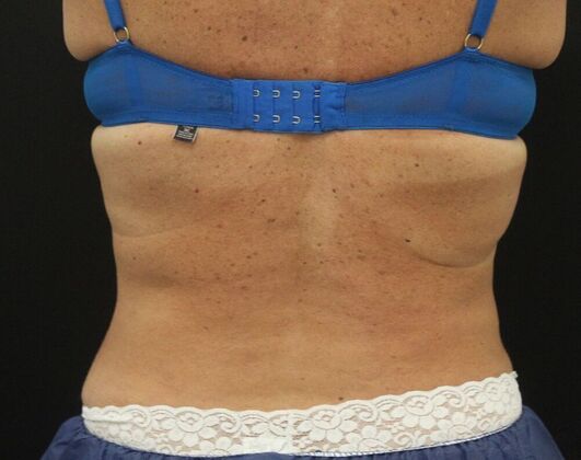 CoolSculpting Case 13 - After