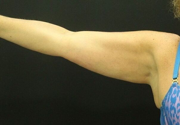 CoolSculpting: Case 13 - After