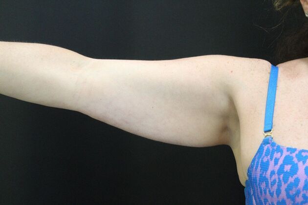 CoolSculpting: Case 13 - Before