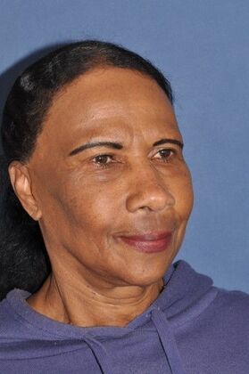 Facelift: Deep plane face and neck lift ! - Before