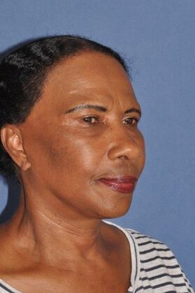 Facelift: Deep plane face and neck lift ! - After