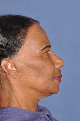 Facelift: Deep plane face and neck lift ! - Before
