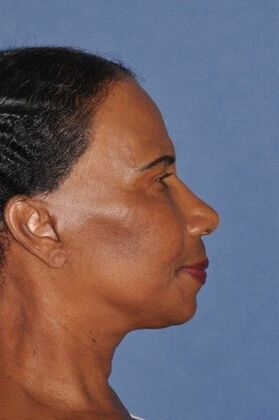 Facelift: Deep plane face and neck lift ! - After