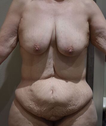 Massive Weight Loss : Case 184 - Before