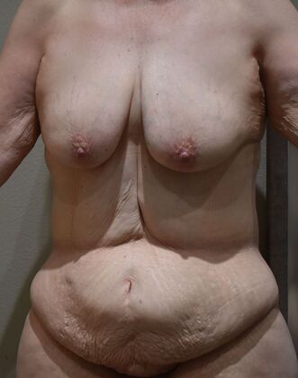 Massive Weight Loss : Case 184 - Before