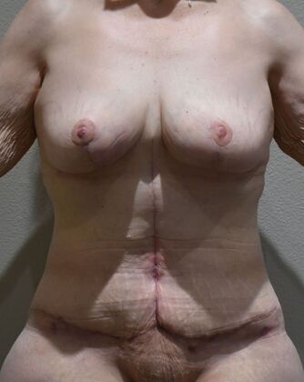 Massive Weight Loss : Case 184 - After