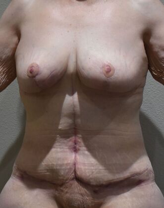 Mommy Makeover: Case 345 - After