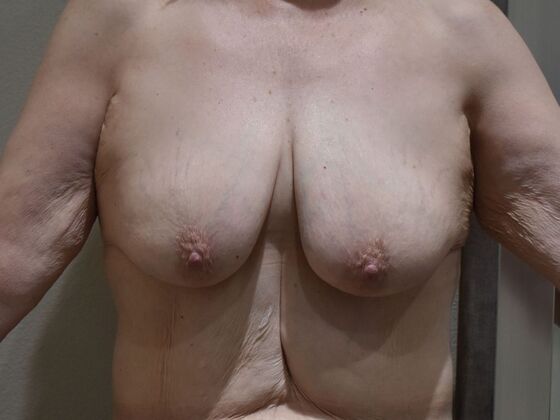 Breast Lift (Mastopexy) Case 249 - Before