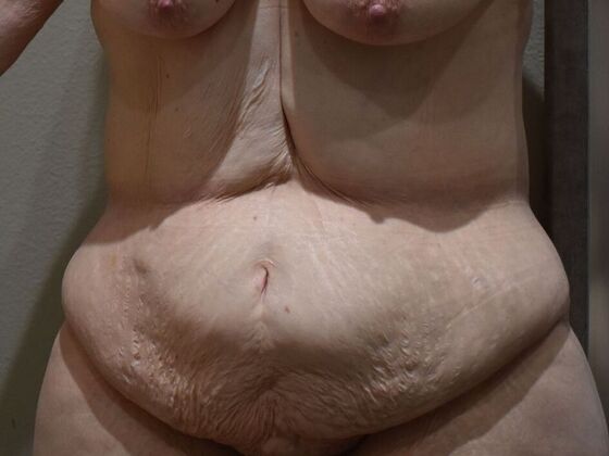 Tummy Tuck (Abdominoplasty): Case 550 - Before