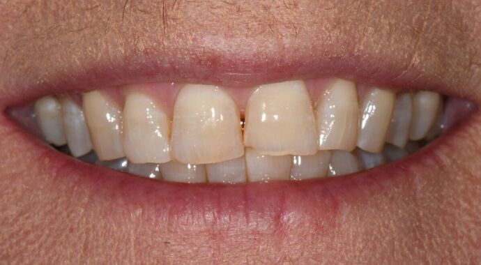 Composite Veneers  Composite Veneers Update Smile - Before