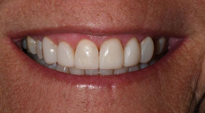 Composite Veneers  Composite Veneers Update Smile - After