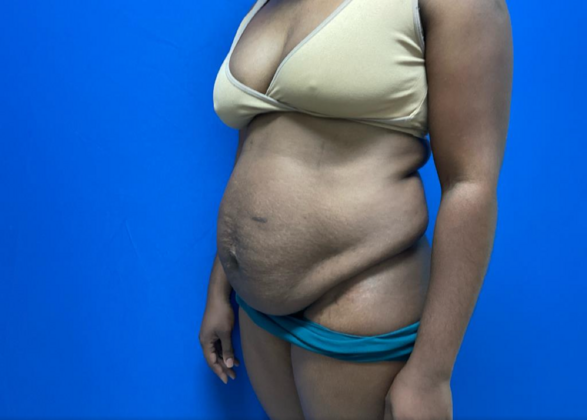 Tummy Tuck: Case 7 - Before