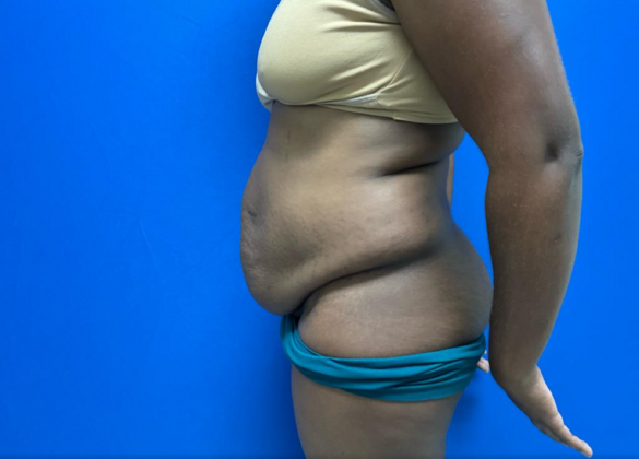 Tummy Tuck: Case 7 - Before