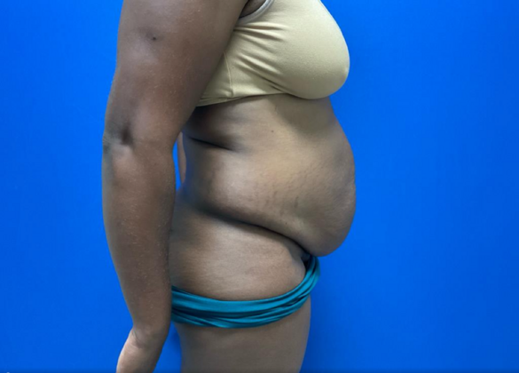 Tummy Tuck: Case 7 - Before