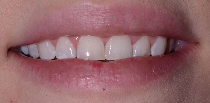 Composite Veneers  Composite Veneers to restore teeth with discoloration and wear - Before
