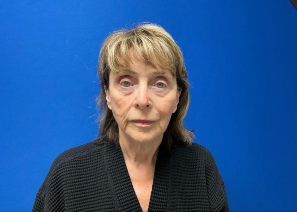 Facelift Case 20 - Before