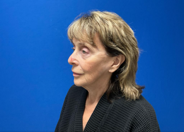 Facelift: Case 20 - Before