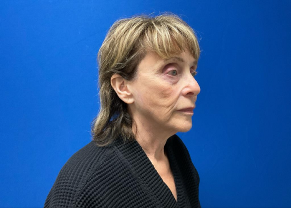 Facelift: Case 20 - Before