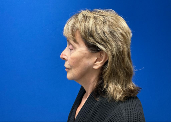 Facelift: Case 20 - Before