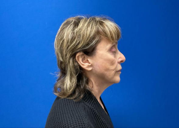 Facelift: Case 20 - Before