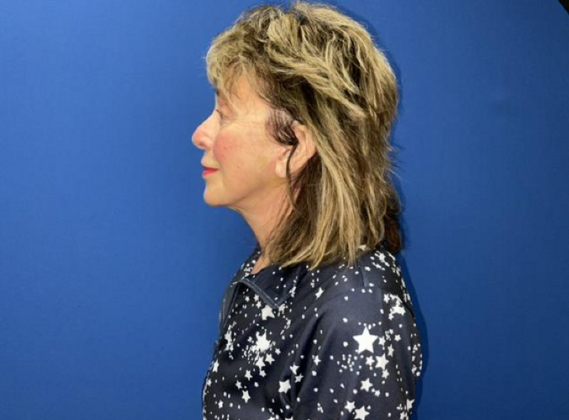 Facelift: Case 20 - After