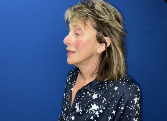 Facelift: Case 20 - After