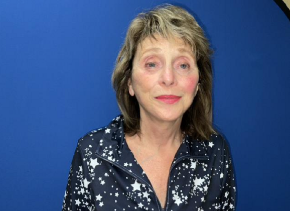 Facelift Case 20 - After