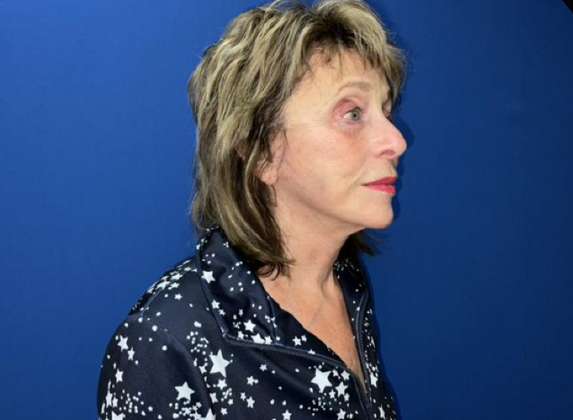 Facelift: Case 20 - After