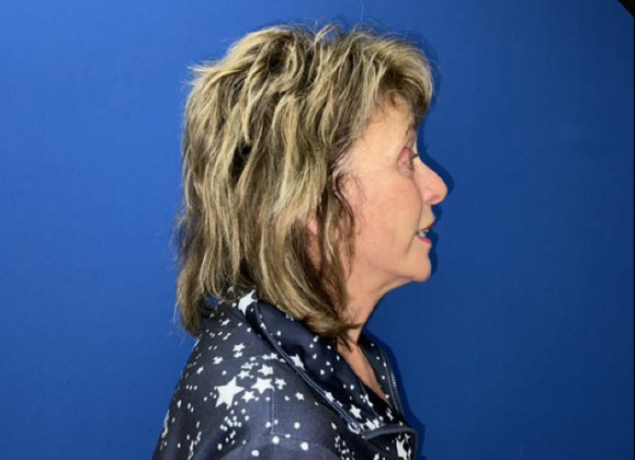 Facelift: Case 20 - After