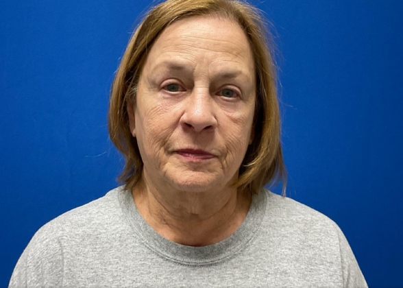 Laser Treatments Case 1 - Before