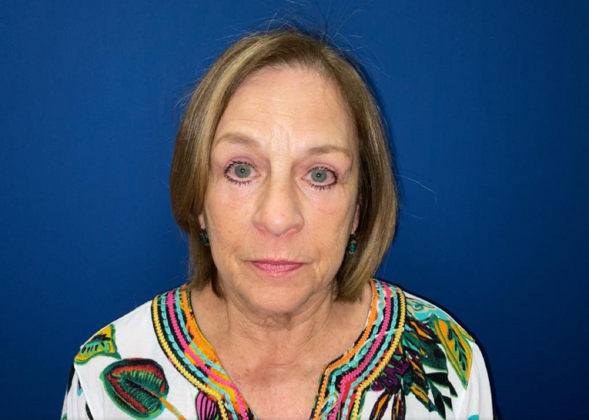 Laser Treatments Case 1 - After