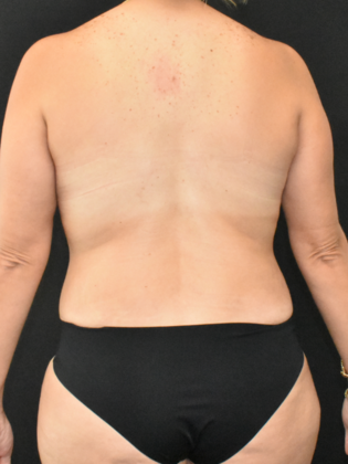 Mommy Makeover: Case 17 - After