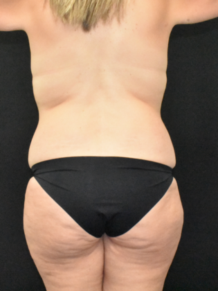 Mommy Makeover: Case 17 - Before