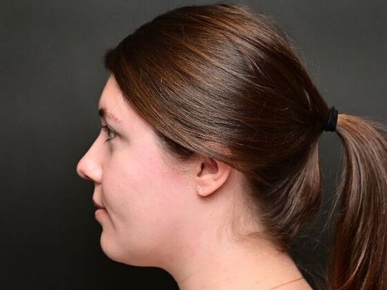 Morpheus8 Face and Neck: Case 1 - Before