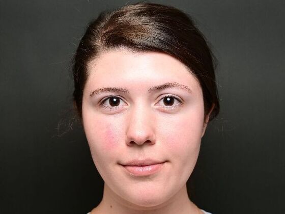 Morpheus8 Face and Neck Case 1 - Before