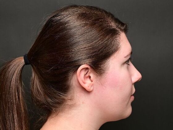 Morpheus8 Face and Neck: Case 1 - Before