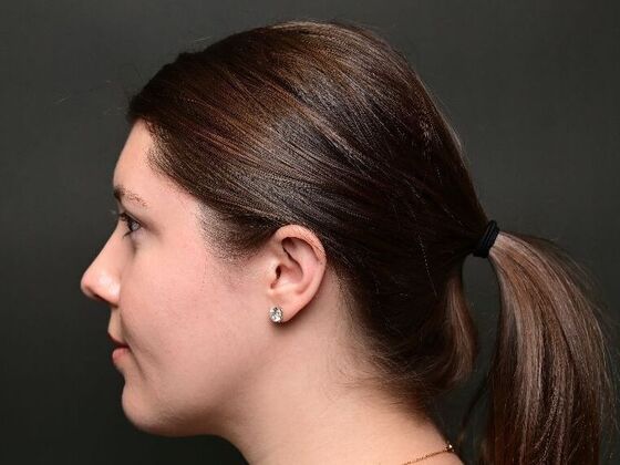 Morpheus8 Face and Neck: Case 1 - After