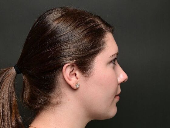 Morpheus8 Face and Neck: Case 1 - After