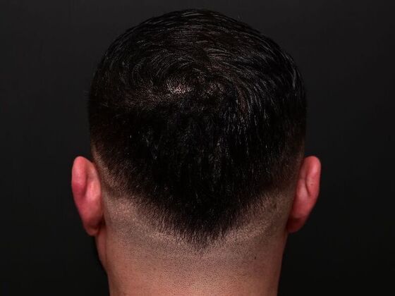 Hair Restoration: Case 6 - After