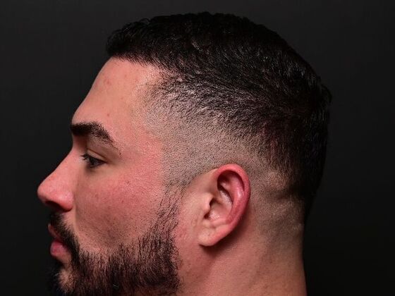 Hair Restoration: Case 6 - After