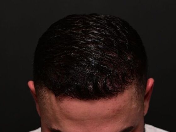 Hair Restoration Case 6 - After