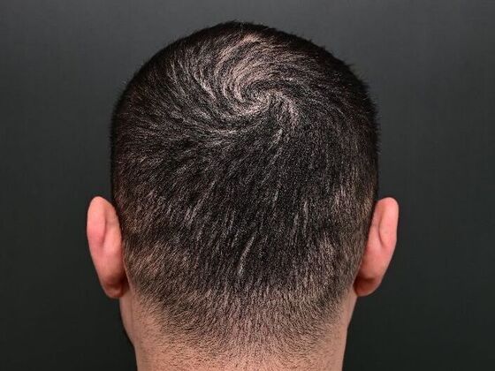 Hair Restoration: Case 6 - Before