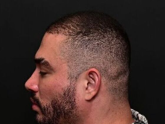 Hair Restoration: Case 6 - Before