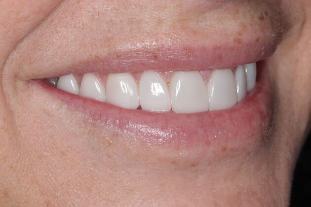 Smile Gallery : Case 1 - After